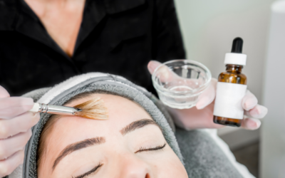 What are the Pros and Cons of a Chemical Peel?